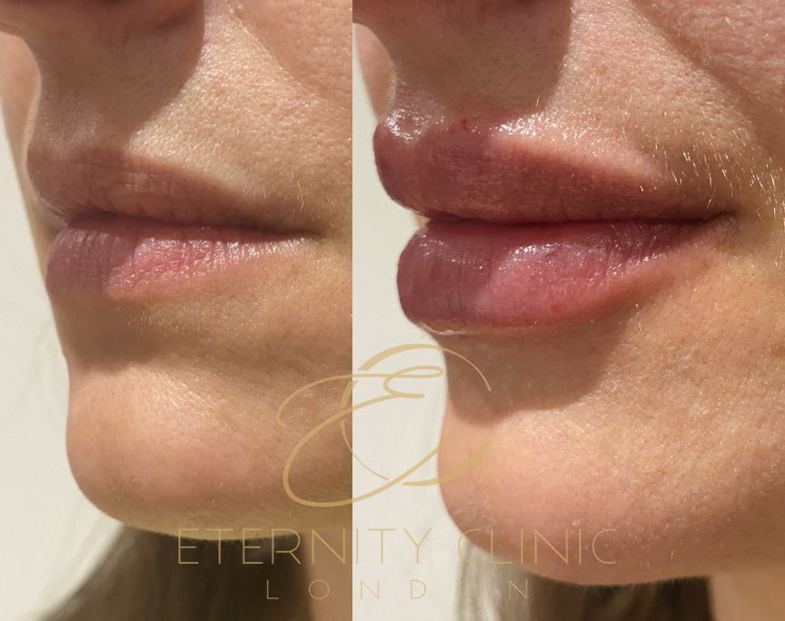 Anti-wrinkle treatment London Harley Street