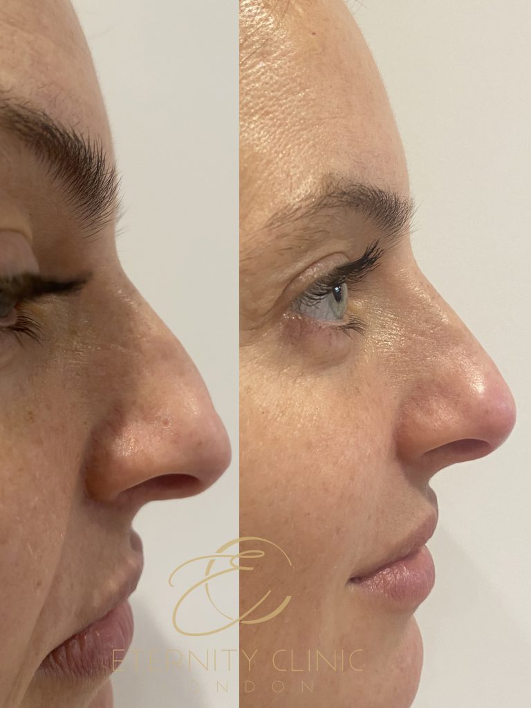 Liquid Nose Job London Harley Street