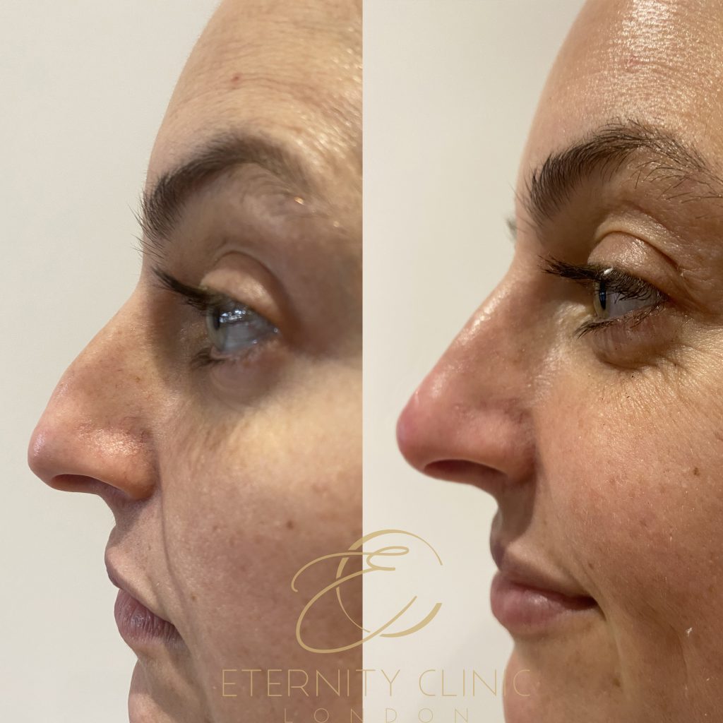 Non-Surgical Rhinoplasty London Harley Street