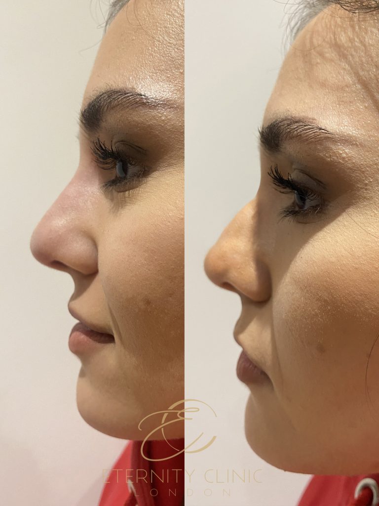 Nose Fillers London Harley Street